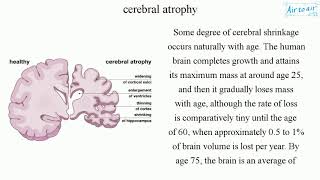 cerebral atrophy (English) - Medical terminology for medical students -