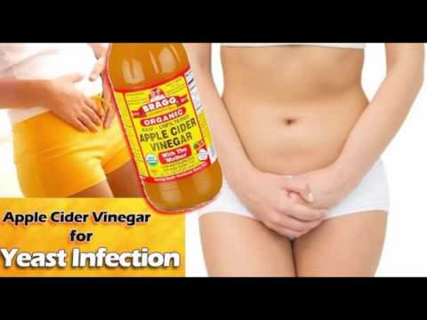 Yeast Infection Treatment By Using Apple Cider Vinegar | Best Yeast Infection Cure Yeast Infection Treatment By Using Apple Cider Vinegar | Best Yeast Infection Cure
