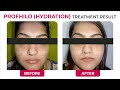 profhilo step by step procedure video real results of the revolutionary skin treatment