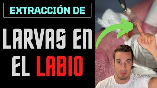 Les extraen LARVAS DE MOSCA de los LABIOS - Parásitos en la BOCA