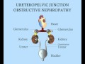 Ureteropelvic Junction - Obstructive Nephropathy