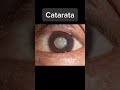 así vemos las enfermedades oculares. parte 1 saludocular ojorojo conjuntivitis