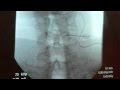 Watch as Dr. McJunkin Performs a Stellate Ganglion Block Live! Watch as Dr. McJunkin Performs a Stellate Ganglion Block Live!