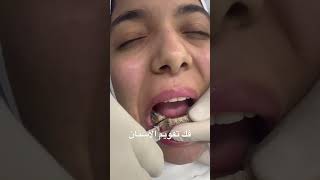 طريقة فك تقويم الأسنان #dentistryworld