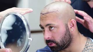 Este Medical Group FUE Hair Transplant  (Follicular Unit Extraction)