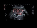 SMI Placenta