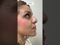 Rinoplastia con ácido hialurónico  |Dr. Alejandro Acuña