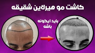 خط رویش و شقیقه باید اینطوری کاشت بشود: 0 تا 100 نکات کاشت هیرلاین و شقیقه