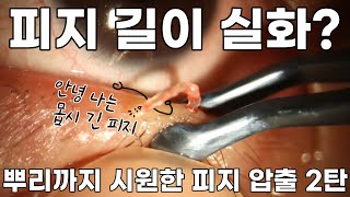 [ENG sub] 세상에서 가장 긴 피지 압출하기!