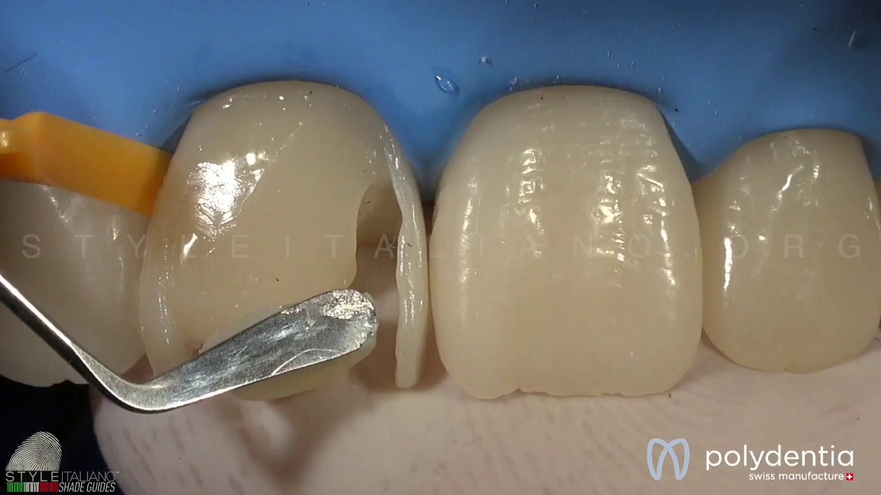 Anterior Teeth Composite Restoration - YouTube