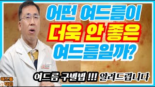 더욱 안 좋은 여드름은, 어떤 여드름일까? 아크네마인드 원장 여드름 닥터가 알려드립니다! #여드름 #여드름없애는방법 #여드름없애는법