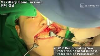 양악수술 동영상 - Orthognathic Surgery: Maxillary Le Fort I Ostetotomy(줌 구강악안면외과)