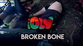 BROKEN BONE - iOliver