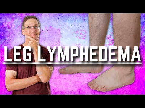 Top 3 Exercises for Leg Lymphedema (Swelling or Edema) Top 3 Exercises for Leg Lymphedema (Swelling or Edema)