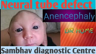 Anencephaly |Neural tube defect |Drshikha Agarwal |Drhome|class 12 biology