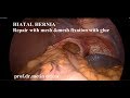 Laparoscopic Hiatal hernia repair with mesh. Metin Ertem MD FACS