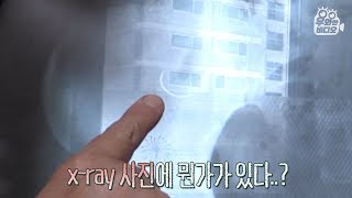 20년동안 배 속 안에 있는 바늘..? 그 이유가.. | Woman Has a Needle in Her Stomach \u0026 Goes Under Surgery