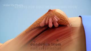 Breast prosthesis|3d medical animation|sample use only by Dandelion Team