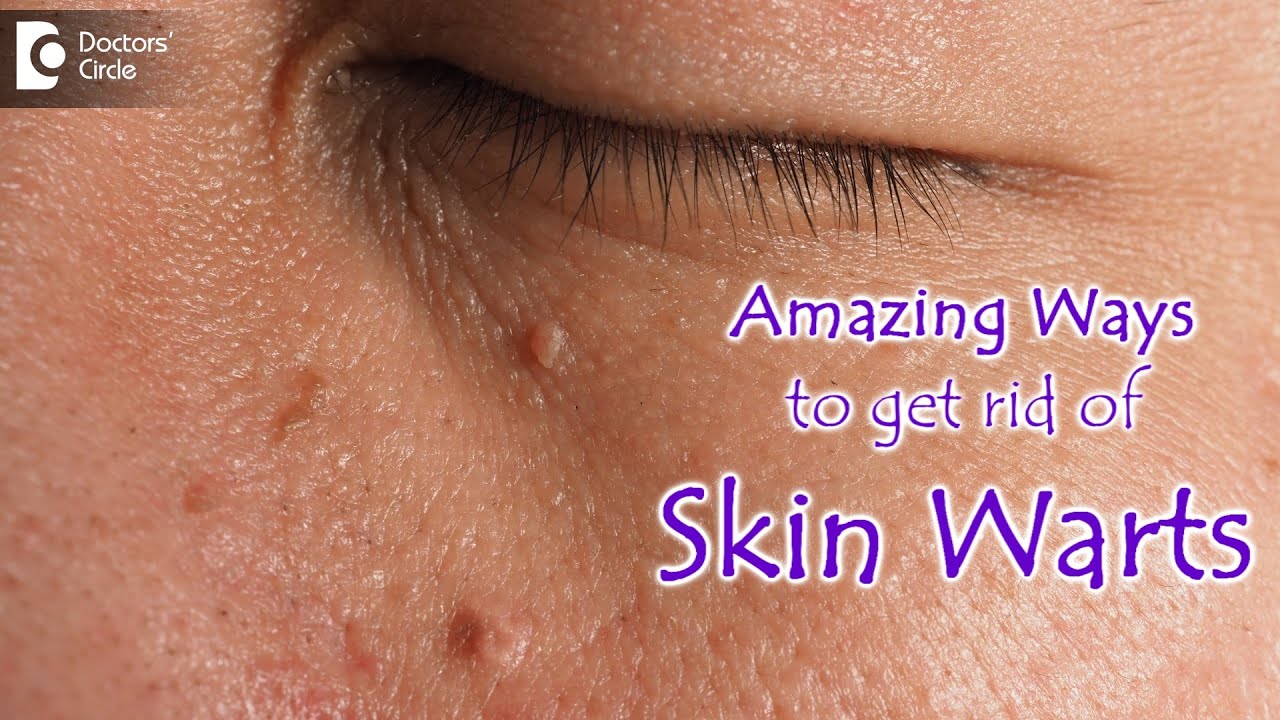 AMAZING WAYS TO GET RID OF SKIN WARTS | Skin Wart Removal Tips - Dr ...