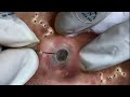 Big Cystic Acne Blackheads Extraction Blackheads & Milia, Whiteheads Removal Pimple Popping #094