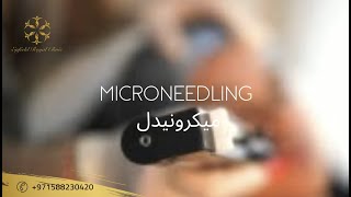 Microneedling in Dubai | RF Microneedling | Price \u0026 Offers | Dynamic Clinic