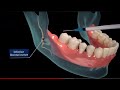 Wisdom Teeth Removal - Step by step