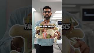 What is the treatment for facet arthrosis? #backpaintreatment #backpain