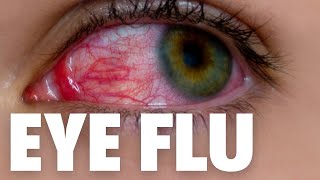Eye flu hone par kya kare | Eye flu kaise hota hai | eye flu kaise thik kare | eye flu symptoms