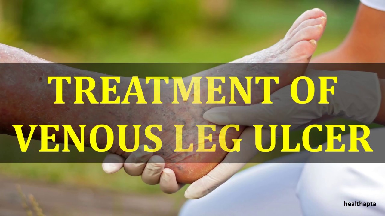 TREATMENT OF VENOUS LEG ULCER - YouTube