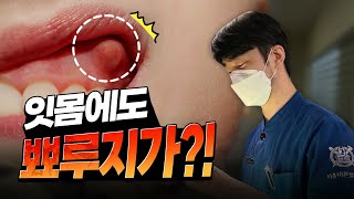 잇몸에도 뾰루지가 날 수 있다? #치과 #잇몸염증