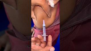 Titanus intramuscular injection 💉😱#doctor #trendingshorts #viralshorts