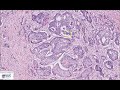 Liver: Metastatic colorectal carcinoma Microscopy (Talking slide)