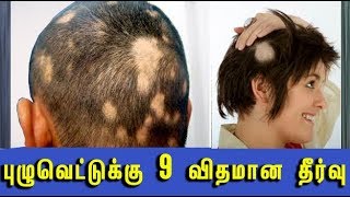 9 ways to cure alopecia areata