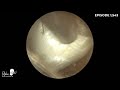 1,543 - Difficult Radical Mastoid Cavity Removal Of Dead Skin