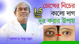 How To Remove Dark Circles | চোখের নিচের কালো দাগ দূর করার উপায় | Choker Nicher Kalo Dag Dur Kora