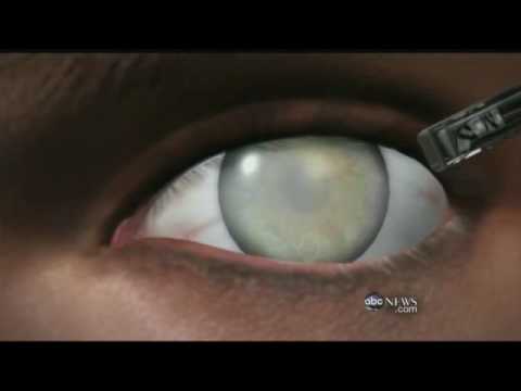 Why do blind eyes turn white?