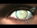 Medical Breakthrough: Restoring Sight to the Blind