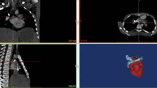 Case #14 : Completion of Extracardiac Fontan Circulation