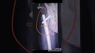 fracture du femur