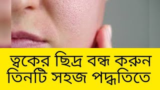 ওপেন পোরস/মুখের গর্ত দূর করার তিনটি সহজ উপায় |open pores remove at home made remedy