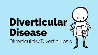 Diverticular Disease | Diverticulitis | Gastrointestinal Society