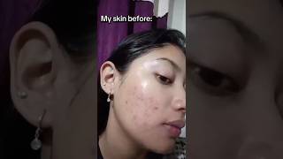 acne healing journey✨ #skincare #acneproneskin #healthyskin #healingjourney #youtubeshorts #glowing