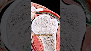 Subacromial bursitis (inflammation of a bursa)