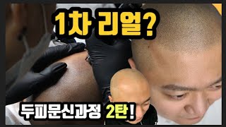 [ 음악가 / 유튜버 ] 두피문신 리얼 영상 제 2편! 1차 작업으로도 자연스러운 커버가 가능하다!