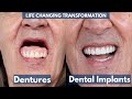 Dentures VS. Dental Implants : Doctors Were Worried About His Health