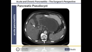 Acute and Chronic Pancreatitis | O. Joe Hines, MD | UCLA Digestive Diseases