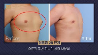 여유증 수술 1만건 실화?!  【여유증 빠른 삭제는 에이징엘】