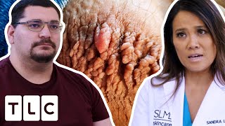 Rupturing Thigh Chafing Keeps Him From Fully Being Part Of His Family | Dr. Pimple Popper