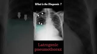 Latrogenic pneumothorax 61#@radiologychannel007