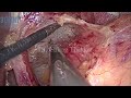 laparoscopic nissen fundoplication surgery minimally edited